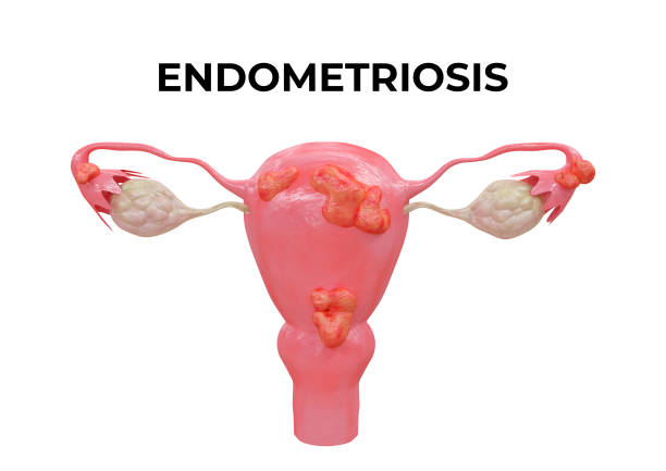 Endometriosis is a disease characterized by the presence of endometrium outside the uterine cavity and in other organs stock photo