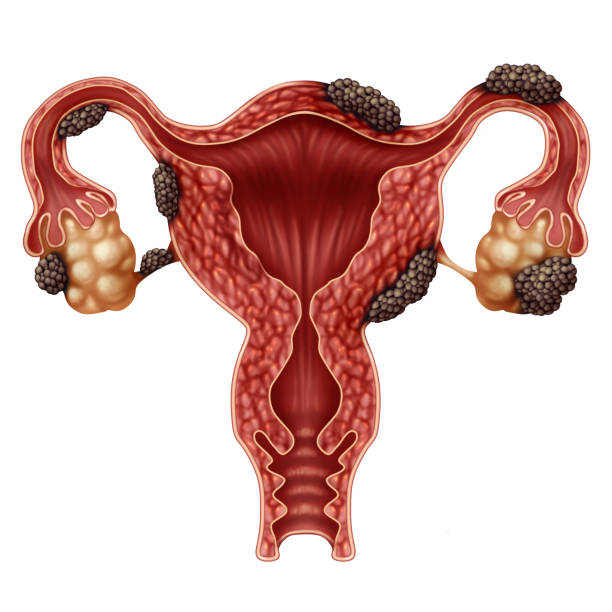 Endometriosis Endometriosis disease anatomy concept as a female infertility condition as a uterus avaries and fallopian tubes with tissue growth with 3D illustration elements. endometriosis photos stock pictures, royalty-free photos & images