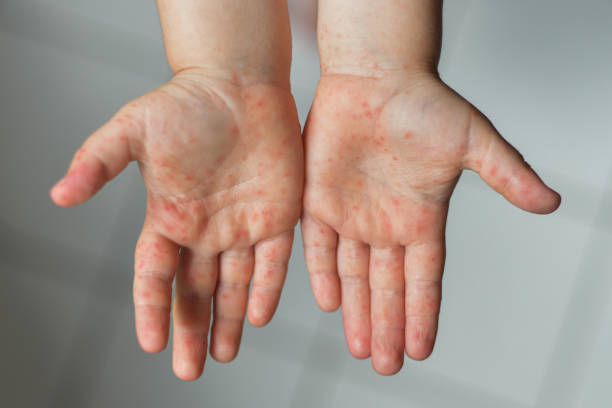 Eczema varicoasă
