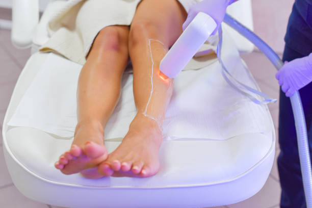 Epilation with a diode laser, hair removal with laser stock photo