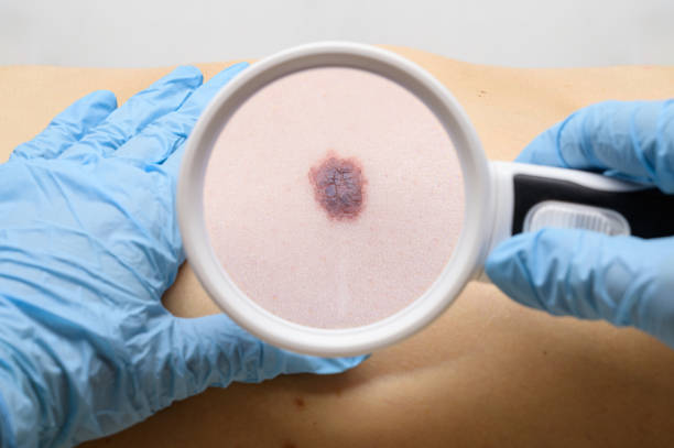 Examination of a mole on the patient's body. The concept of studying moles to prevent the development of skin cancer or melanoma. Examination of a mole on the patient's body. The concept of studying moles to prevent the development of skin cancer or melanoma. dermatologist stock pictures, royalty-free photos & images