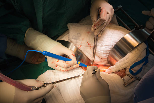 59 Laparotomy Stock Photos, Pictures & Royalty-Free Images - iStock