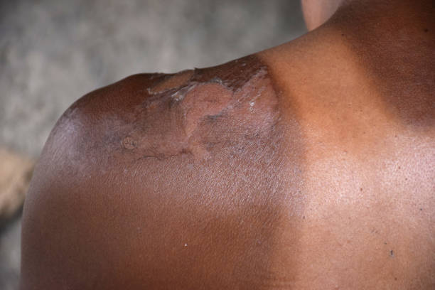 Extra sun-scorched shoulders and neck skin, The body part between the lateral upper joint of the human arm and the neck, reaction to injury or infection Extra sun-scorched shoulders and neck skin, The body part between the lateral upper joint of the human arm and the neck, reaction to injury or infection bed bug heat stock pictures, royalty-free photos & images