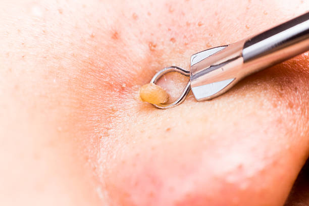 extracting pimple blackheads from the nose with a tool - abces stockfoto's en -beelden