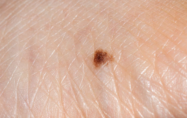 Extreme close up of a skin mole Extreme close up of a skin mole macro body hair stock pictures, royalty-free photos & images