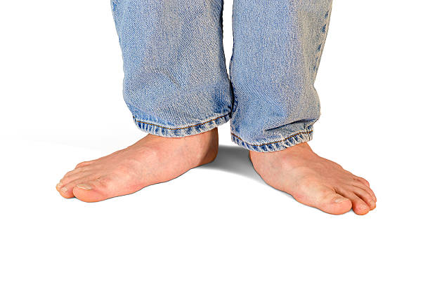 Extreme flat feet problems with fallen arches stock photo