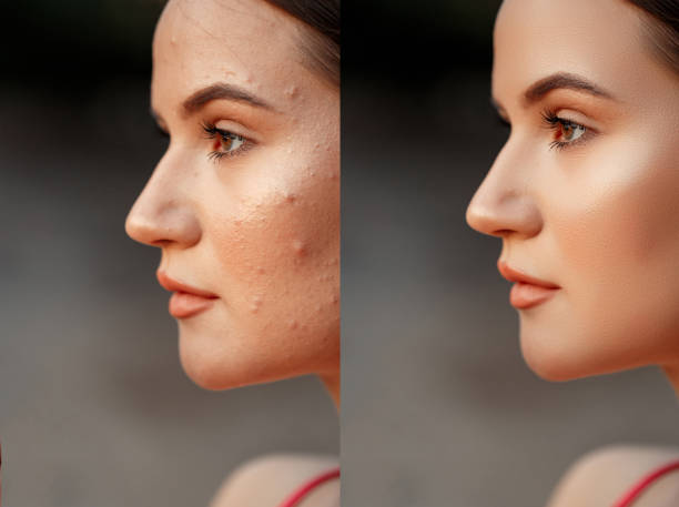 face with acne and pimples close-up. shallow DOF. selective focus. before and after retouching(after applying acne remedies). stock photo
