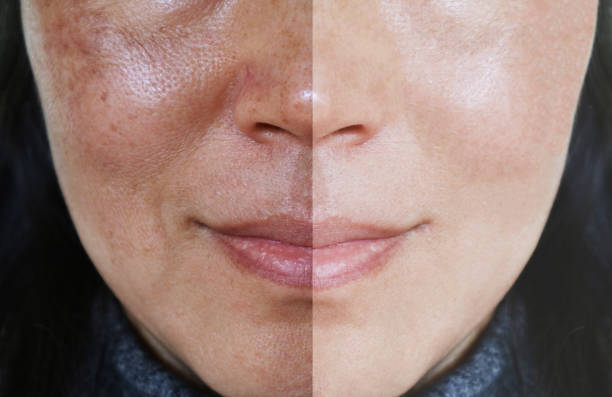 Face with open pores and melasma before and after make up or treatment concept. Face with open pores and melasma before and after make up or treatment concept. comparison photos stock pictures, royalty-free photos & images