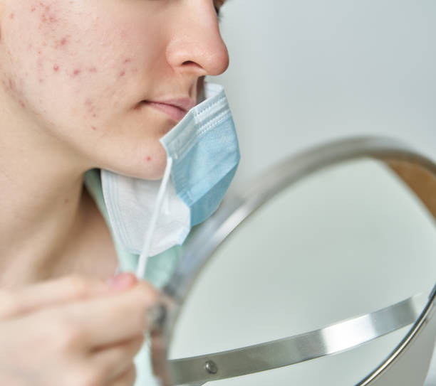 Faceless young female with problem skin wearing medical mask stock photo