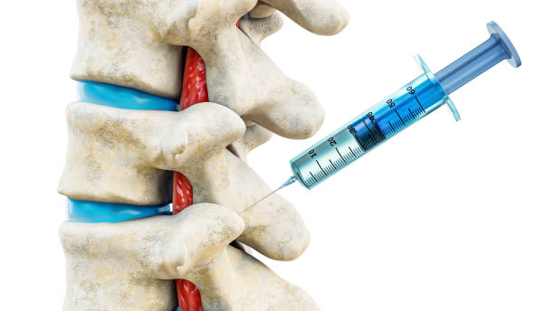 Facet joint injection, therapy against backbone injury or pain. Close-up of vertebrae with a syringe isolated on a white background 3D rendering illustration. Medical and healthcare, anatomy, medicine concept. Facet joint injection, therapy against backbone injury or pain. Close-up of vertebrae with a syringe isolated on a white background 3D rendering illustration. Medical and healthcare, anatomy, medicine concept. medical injection stock pictures, royalty-free photos & images