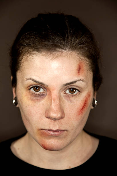 Facial Injuries Injuries to the face caused by physical abuse simulated with stage make-up.  Image may be used to represent domestic violence or other physical assault. Shot indoors with ringflash and studio lights with narrow depth of field black eye stock pictures, royalty-free photos & images