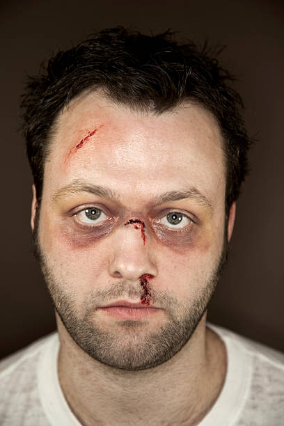 Facial Injuries Injuries to the face caused by physical abuse simulated with stage make-up.  Image may be used to represent domestic violence or other physical assault. Shot indoors with ringflash and studio lights with narrow depth of field black eye stock pictures, royalty-free photos & images