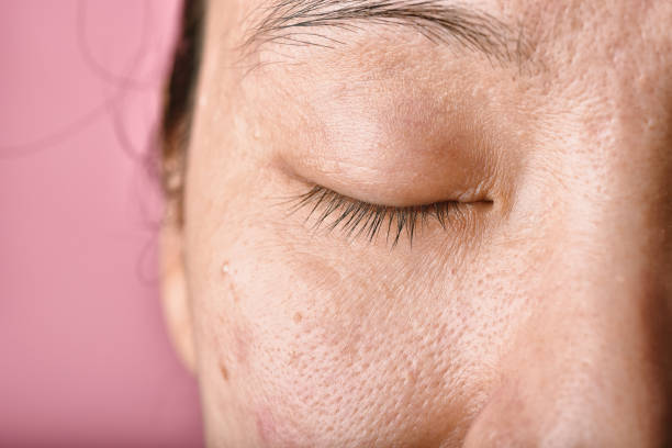 Facial skin problem, Aging problem in adult, wrinkle, acne scar, large pore and dark spot, Dehydrate skin. stock photo