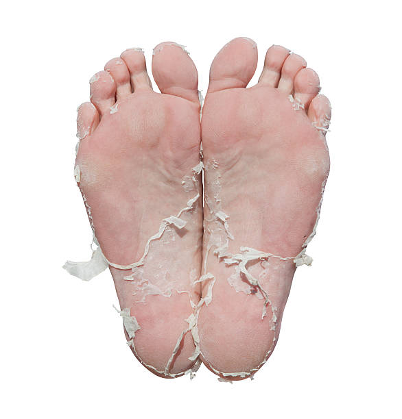 Feet In Wery Bad Condition stock photo