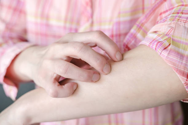 Female fingers scratch the itchy skin on the hand, against the background of a pink plaid shirt. stock photo