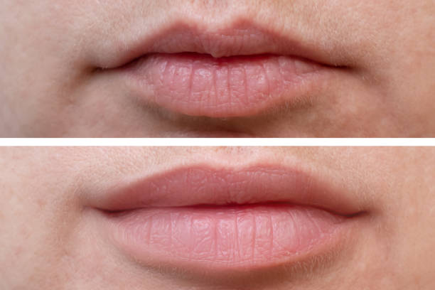 Female lips before and after augmentation, the result of using hyaluronic filler stock photo