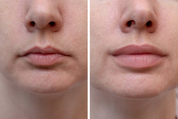Female lips before and after augmentation, the result of using hyaluronic filler stock photo