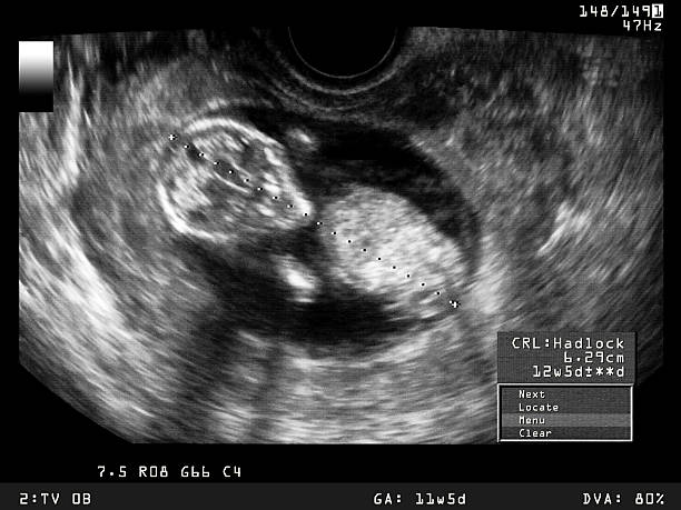 Fetus Ultrasound stock photo