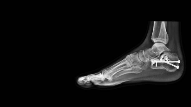 Film ankle X-ray radiograph showing heel bone broken (calcaneus fracture) which treated by open reduction and internal fixation(ORIF) with plate and screws. Medical technology and instrument concept. calcaneus broken treated by surgical implant x ray plates stock pictures, royalty-free photos & images