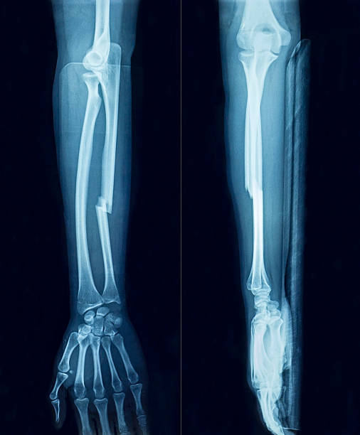 Film x-ray arm Film x-ray show fracture plate of arm for fix arm's bone x ray plates stock pictures, royalty-free photos & images