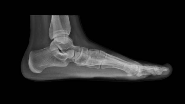 Film X-ray foot radiograph show Flat foot deformity (pes planus or fallen arches) and abnormal union of tarsal bone( Calcaneonavicular coalition). The patient has foot,ankle pain ankle problem Film X-ray flat foot coalition stock pictures, royalty-free photos & images