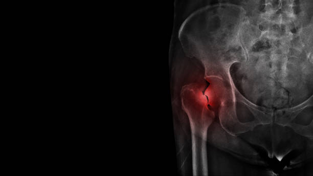 film-röntgen-hüft-röntgenzeigen zeigen gebrochenen hüftknochen (hals der oberschenkelfraktur ) mit freiem kopierraum. ältere patienten haben osteoporose und versehentlichen sturz zu hause. pflege- und fallpräventionskonzept. - hüfte stock-fotos und bilder