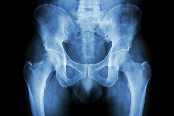 Film x-ray normal pelvis stock photo