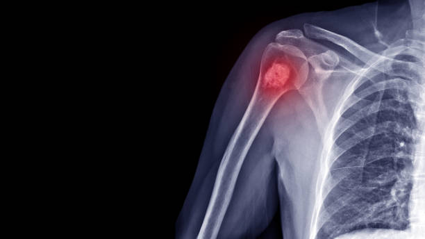 Film X-ray shoulder radiograph show Enchondroma disease at arm bone. Enchondrama is a benign tumor of cartilage grow within bone and expand it. Highlight on mass lesion. Medical oncology concept enchondroma cyst photos stock pictures, royalty-free photos & images