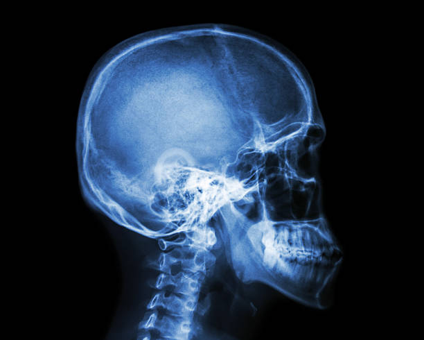 Film x-ray skull and cervical spine lateral view stock photo