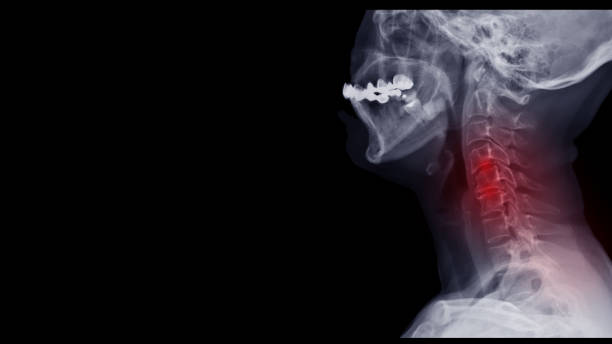 Film x-ray spine radiograph show cervical spondylosis  which is spinal disc degenerative disease. The patient is phone addiction and has neck pain, numbness and weakness. Highlight on painful area. Cervical spondylosis disease disk stock pictures, royalty-free photos & images