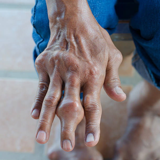 ujj osteoarthritis vállízületi betegségek kezelése