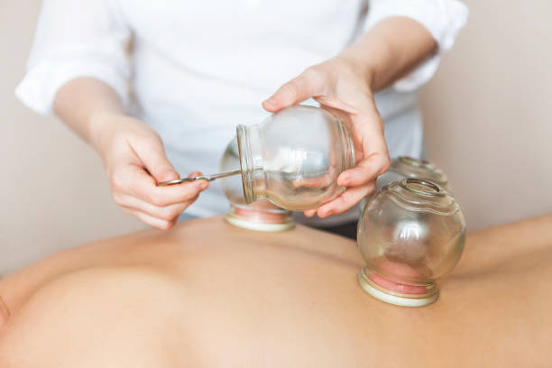 Fire cupping cups on back of female patient in Acupuncture therapy stock photo
