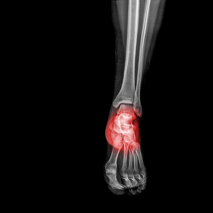 Picture of an ankle pain xray.