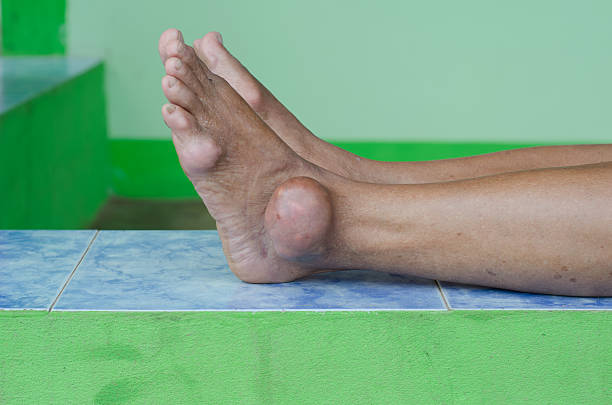 what cause gout