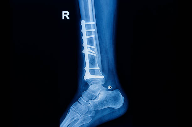 Fracture ankle fibula bone ( leg bone ) X-ray of ankle with plate and screw Fracture ankle fibula bone ( leg bone ) X-ray of ankle with plate and screw x ray plates stock pictures, royalty-free photos & images