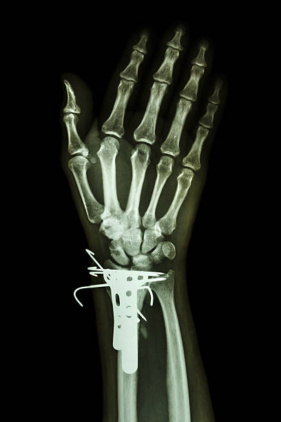 fracture distal radius (forearm's bone). It was operated and ins film x-ray wrist AP : show fracture distal radius (forearm's bone). It was operated and inserted plate and K-wire(Kirschner wire) x ray plates stock pictures, royalty-free photos & images