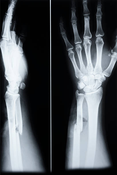 Fracture Of Ulna(Arm) and third metacarp(hand) stock photo
