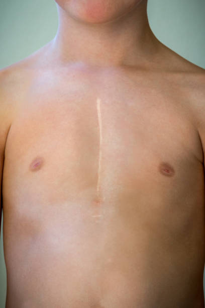 Front view of young caucasian boy with healed surgical scar after heart surgery. stock photo