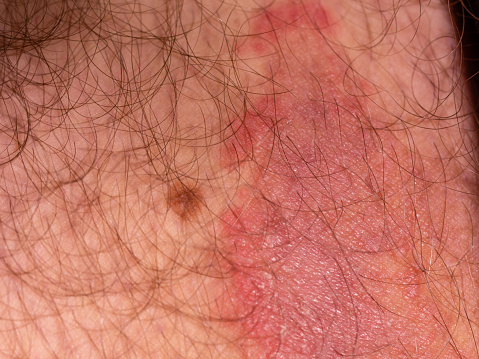 erkek bacak deride mantar enfeksiyonu stok fotograflar aci nin daha fazla resimleri istock