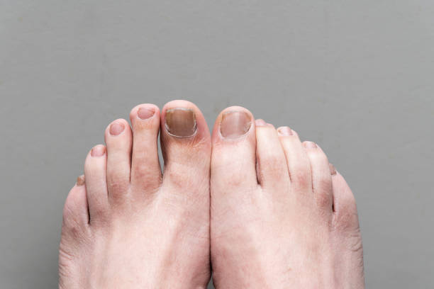 Fungal nail infection stock photo