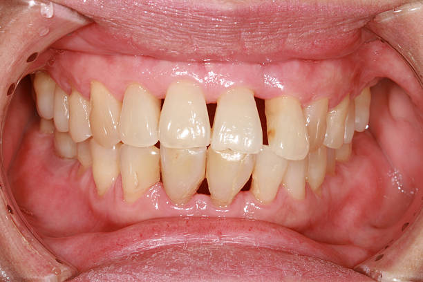 gingival recession. stock photo