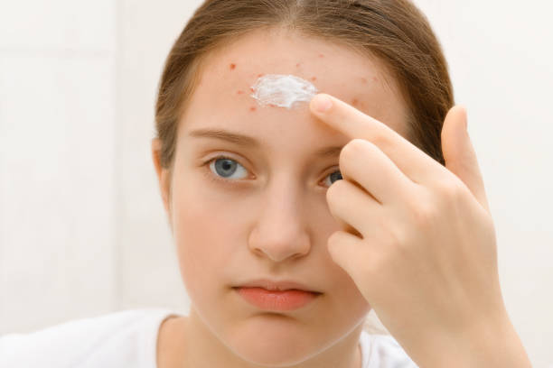 girl puts cream on her face, face of a teenage girl with pimples, acne on the skin, she looks at herself in the mirror, concept of beauty and health stock photo