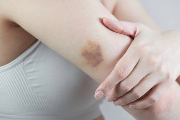 Girl shows a real bruise on her hand closeup stock photo