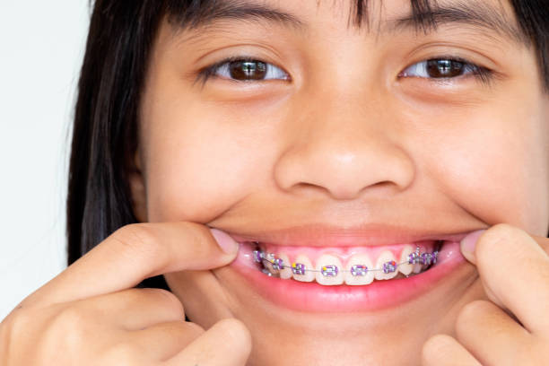 Girl with braces teeth smiling and happy stock photo