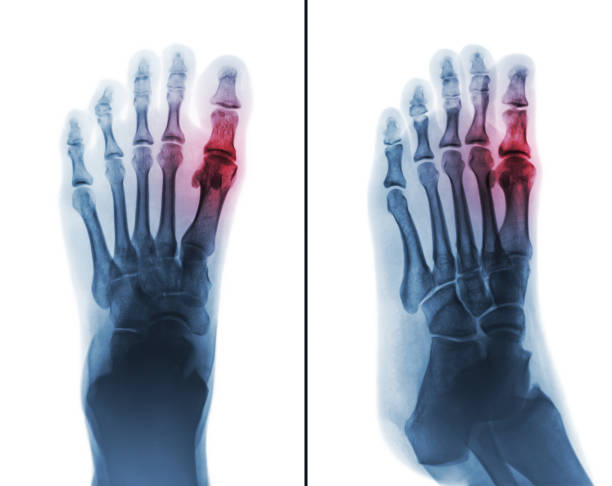 Gouty arthritis . film x-ray of human foot and arthritis at first metatarsophalangeal Joint . stock photo
