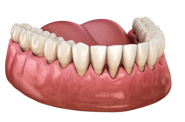 Gum recession process. Medically accurate 3D illustration stock photo