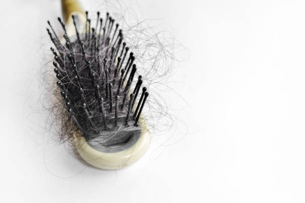 Hair loss concept of close up hairbrush and fallen hair stock photo