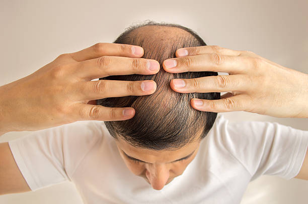 Hair loss close up of man controls hair loss 2015 stock pictures, royalty-free photos & images