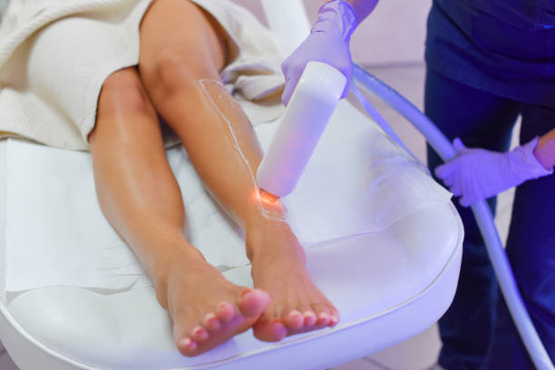 Hair removal with laser diod stock photo