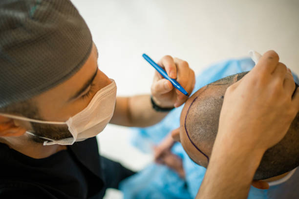 Hair transplant stock photo